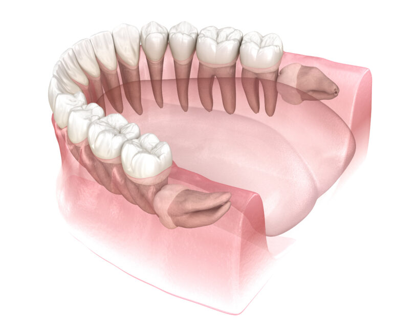 Why Your Wisdom Teeth May Need Extraction El Paso TX