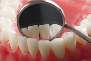 How Do Tooth Colored Fillings Work?