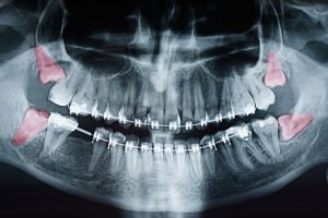 See This Report on Wisdom Teeth Growing In