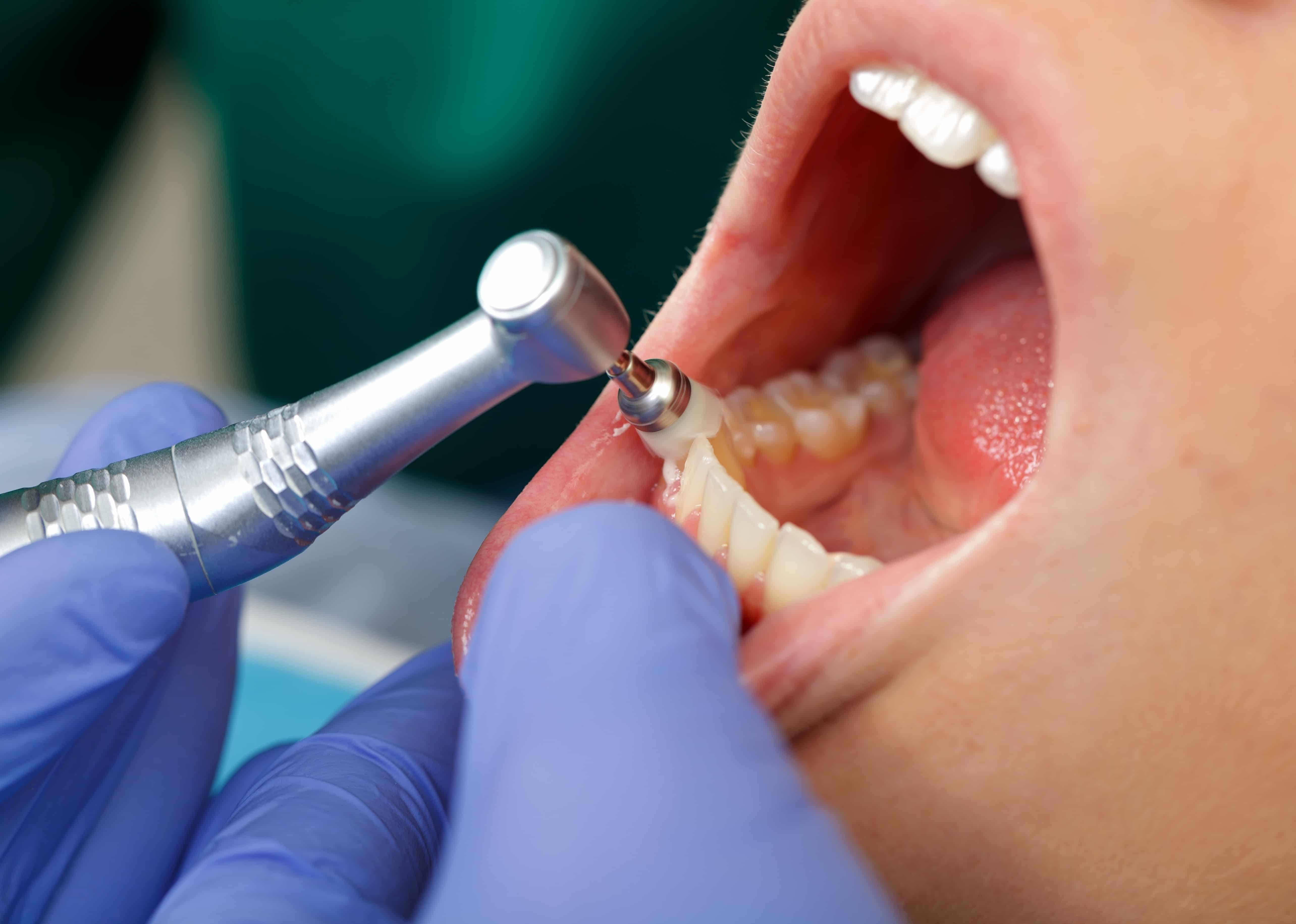 Полость рта для стоматолога. Профгигиена (ультразвук + Air-Flow). Профгигиена полости рта Air Flow. Профессиональная чистка зубов.