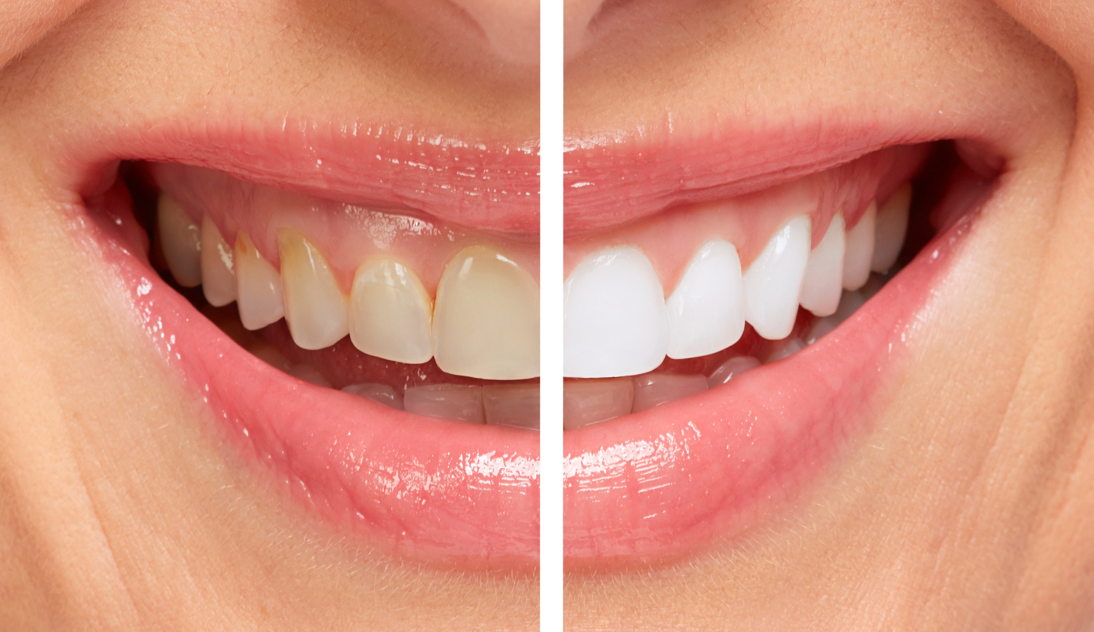 How To Clean Brown Teeth To White