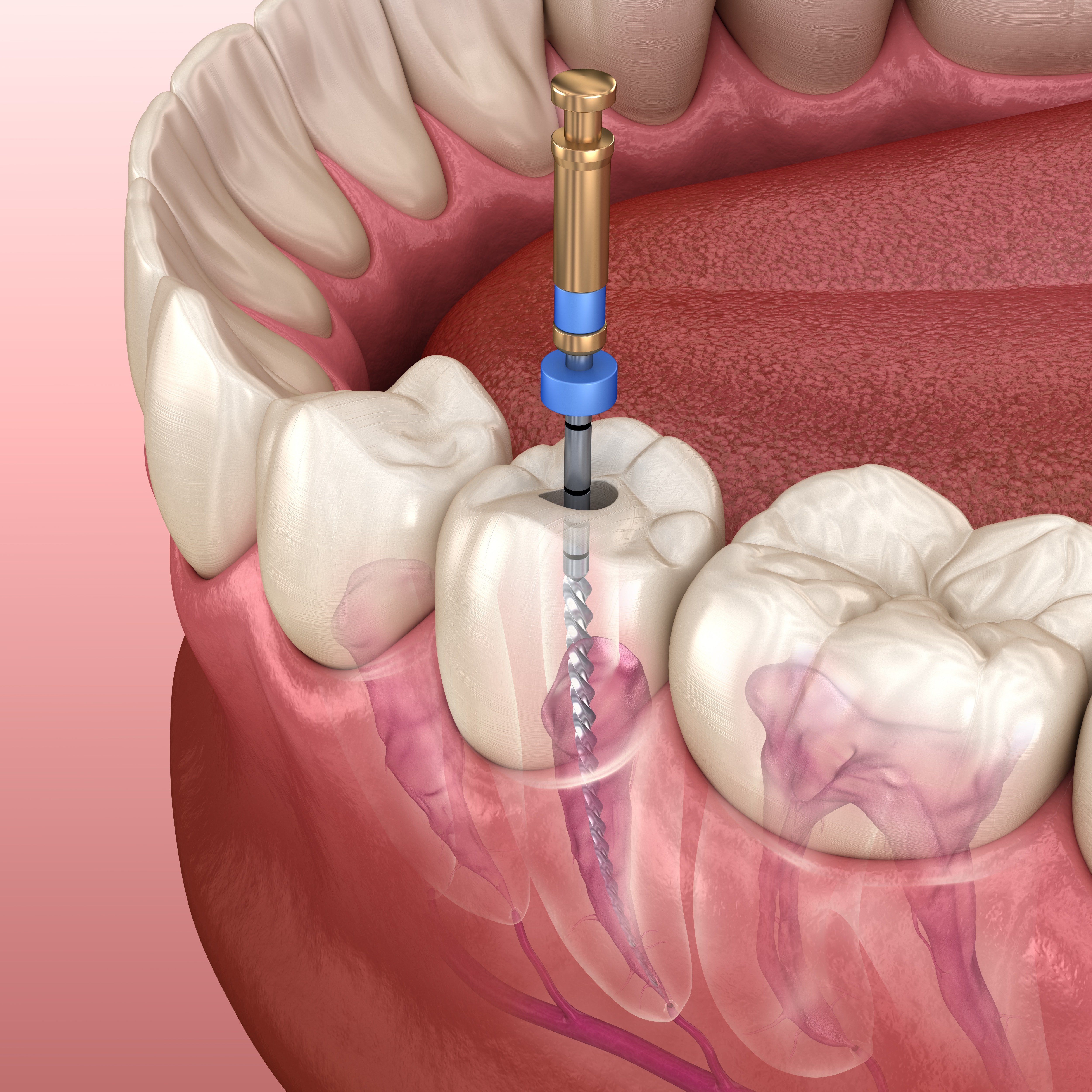 El Paso Dentists Explain What A Root Canal Involves El Paso Tx