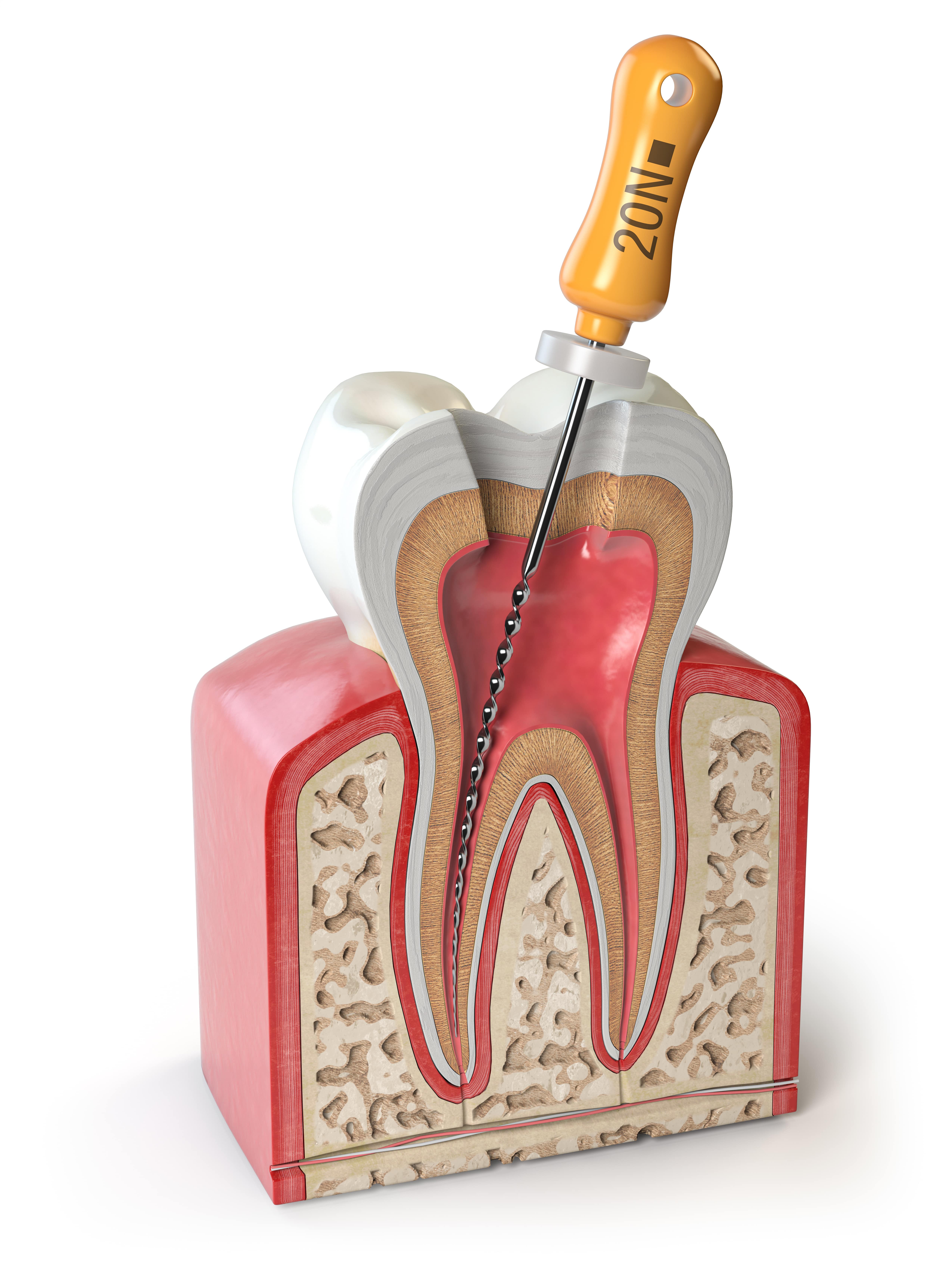 Картинка зуба с файлом эндодонтическим