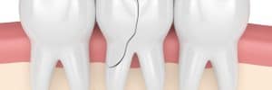 treating cracked tooth with a root canal