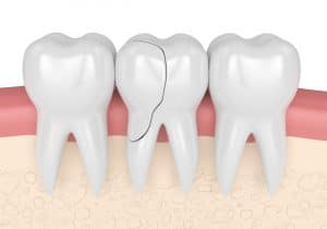 treating cracked tooth with a root canal