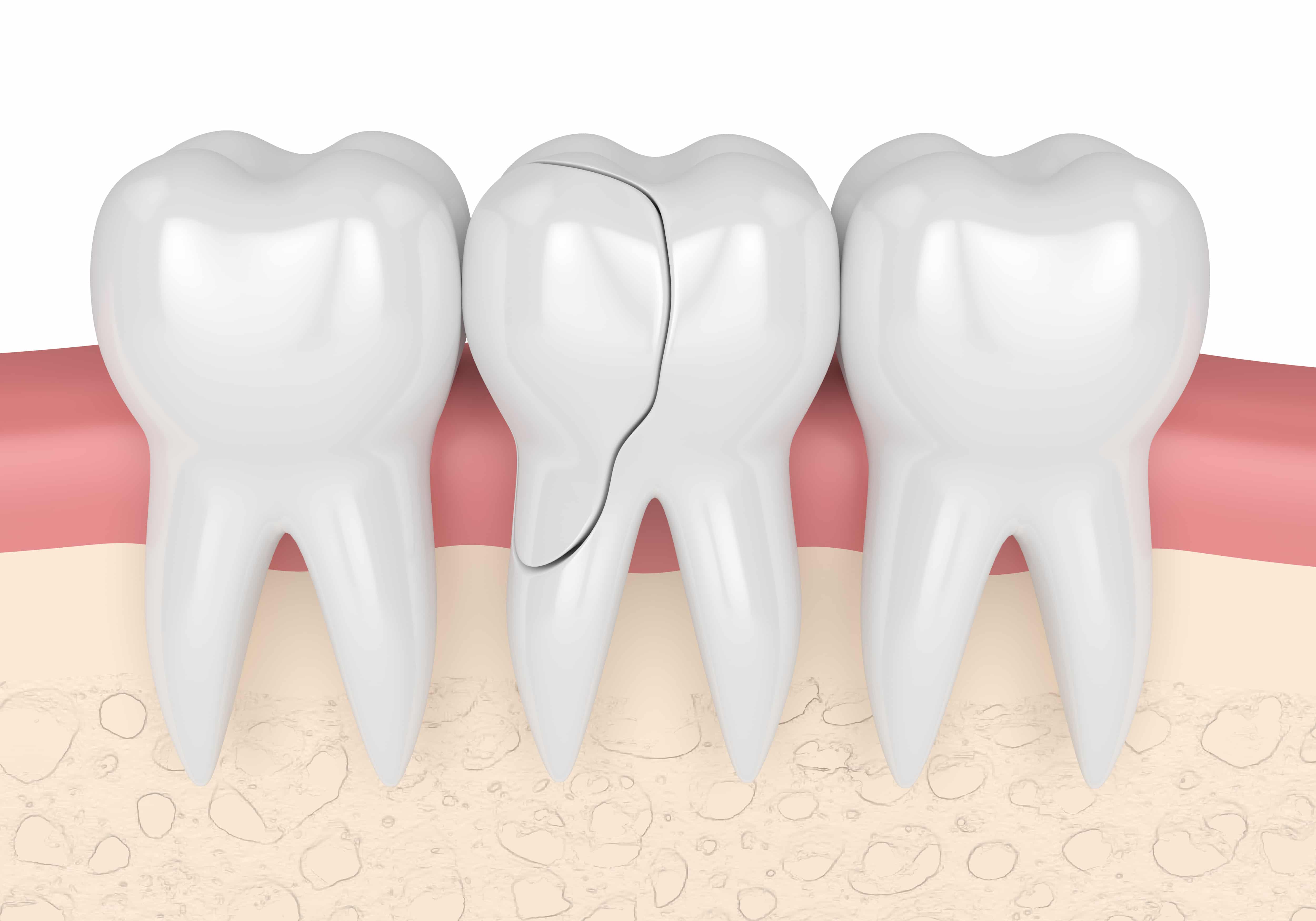 What To Do If You Crack Chip Or Break A Tooth - Radiance Dental