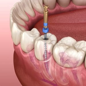 infected tooth