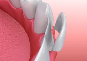 placing porcelain veneers