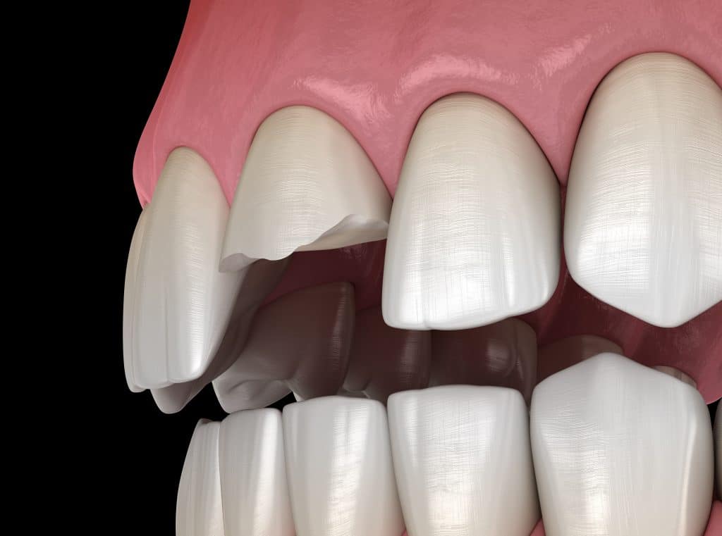 El Paso Dentists Reshape Smiles With Bonding And Contouring El Paso, TX