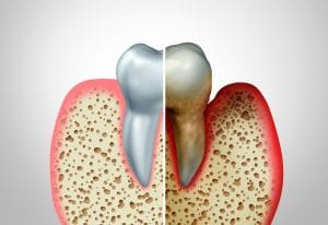 treatment to control gum disease