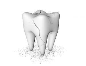 cracked tooth