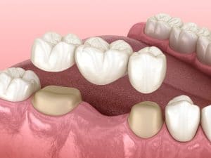 placing a dental bridge