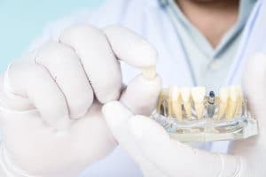 dental implant placement