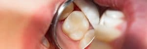 biocompatible dental filling