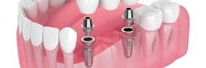 securing bridges with dental implants