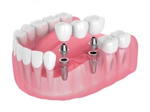 securing bridges with dental implants