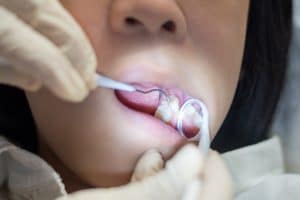 minimal restorations for children