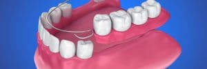 placing a partial denture