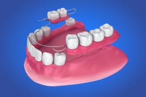 placing a partial denture