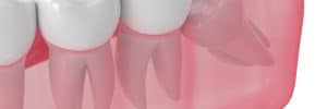 preventing wisdom tooth impaction with extraction