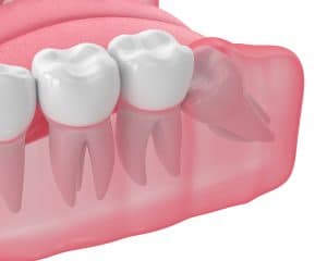 preventing wisdom tooth impaction with extraction