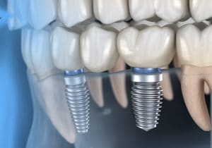 el paso implant bridges