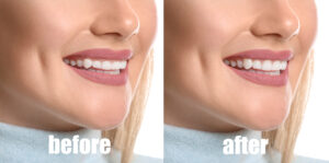 Fixing Your Gummy Smile With Contouring