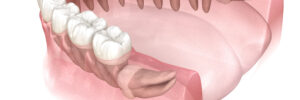 el paso wisdom tooth extraction