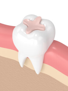 el paso dental fillings