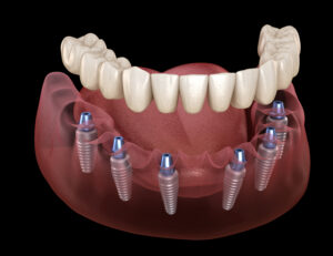 el paso implant dentistry