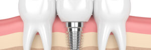 el paso dental implant