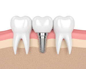 el paso dental implant