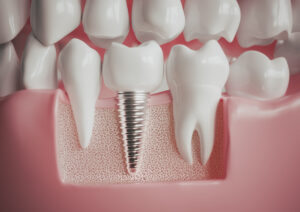 el paso dental implants