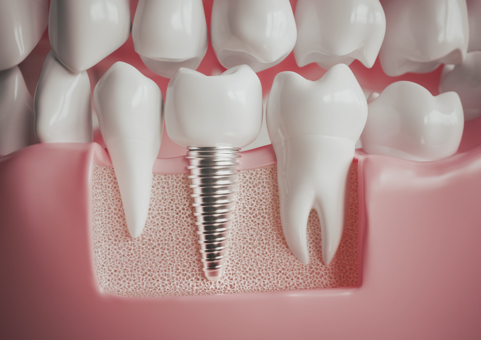 How Dental Implants Support New Teeth El Paso, TX