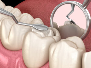el paso dental fillings