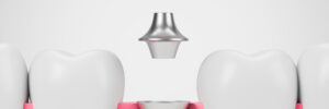 el paso dental implants same-day