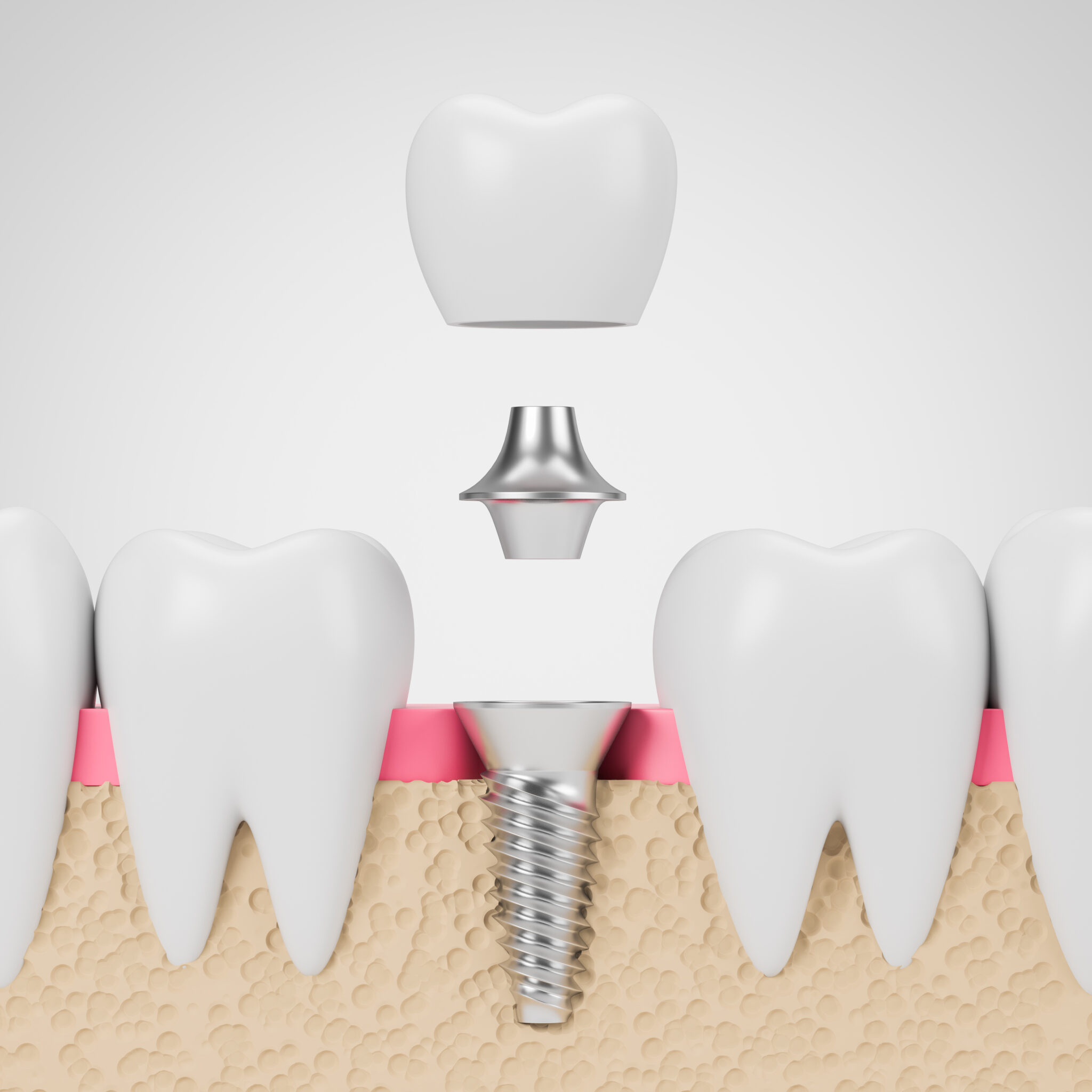Replacing Teeth With SameDay Dental Implants El Paso, TX