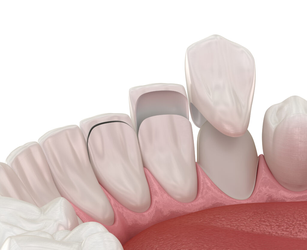 Make Your Smile Shine With Porcelain Veneers El Paso, TX