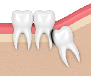 el paso wisdom teeth