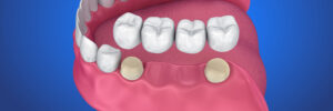 el paso dental bridges