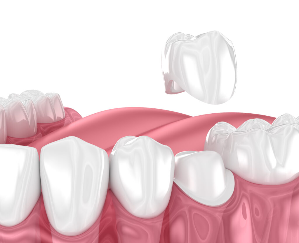 Dental Crowns Can Repair Your Tooth El Paso, TX