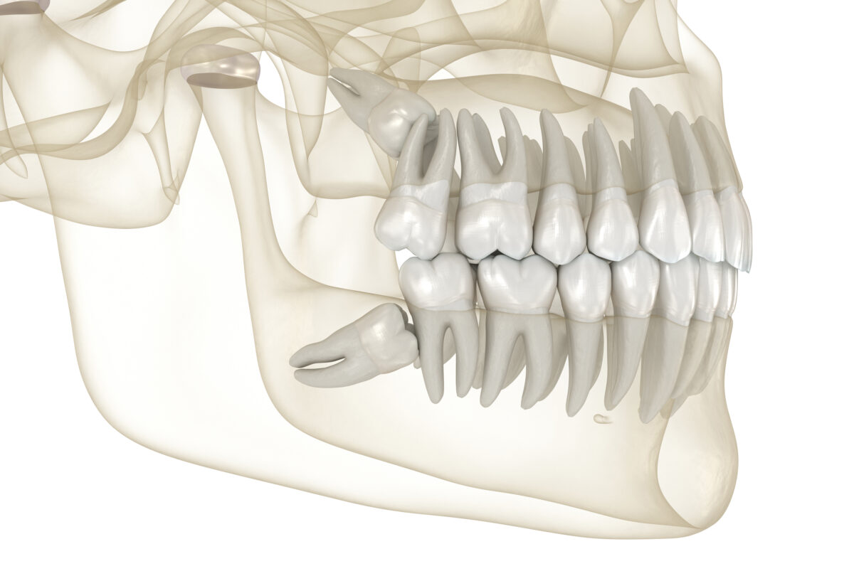 The Dangers Caused By Wisdom Tooth Eruption El Paso, TX