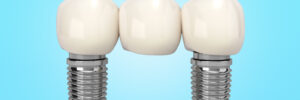 el paso dental implants same day