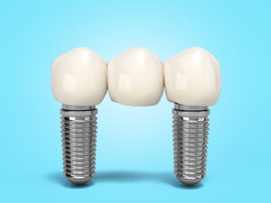 el paso dental implants same day