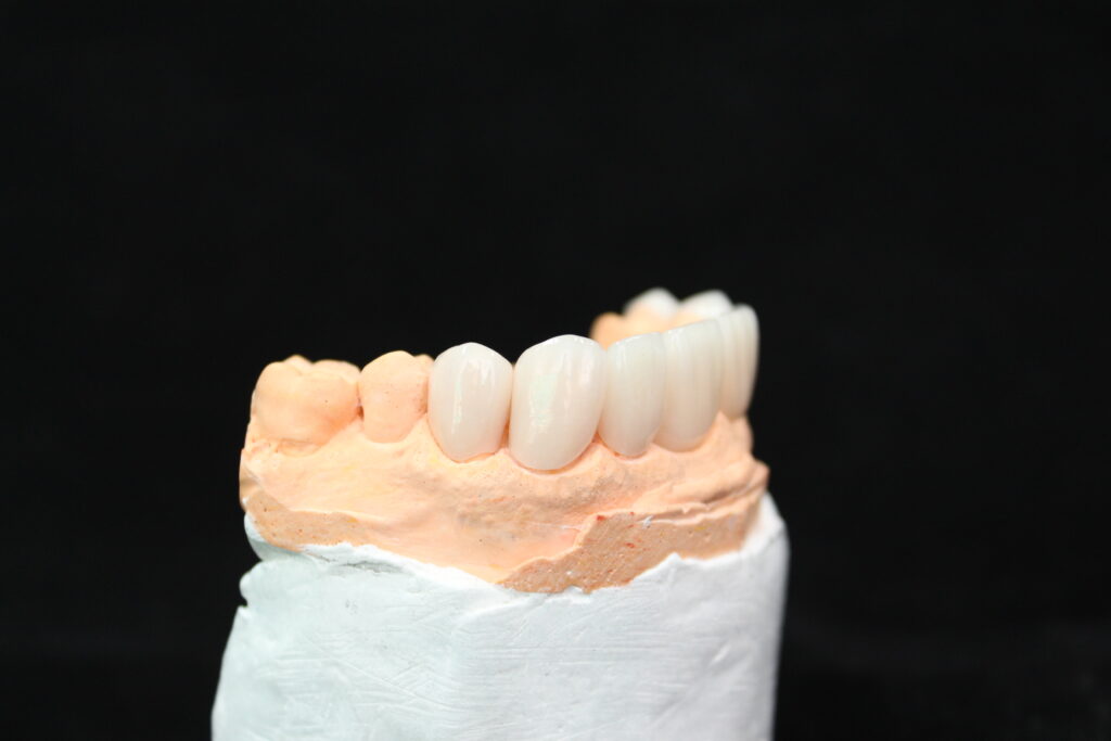 Boost Smile Beauty With Our Porcelain Veneers El Paso, TX