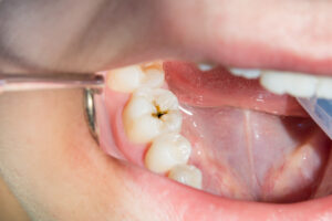 close-up of a human rotten carious tooth at the treatment stage in a dental clinic. The use of rubber dam system with latex scarves and metal clips, production of photopolymeric composite fillings