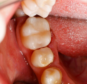 El Paso, TX, dentist offers fillings to restore cavities 