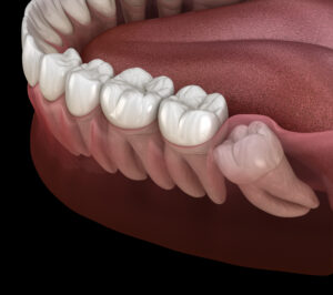 El Paso, TX, dentist offers wisdom tooth removal 