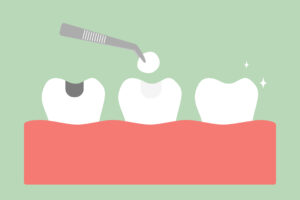 El Paso, TX, dentist offers composite resin fillings 