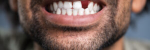 El Paso, TX, dentist offers bridges and dentures to address tooth loss